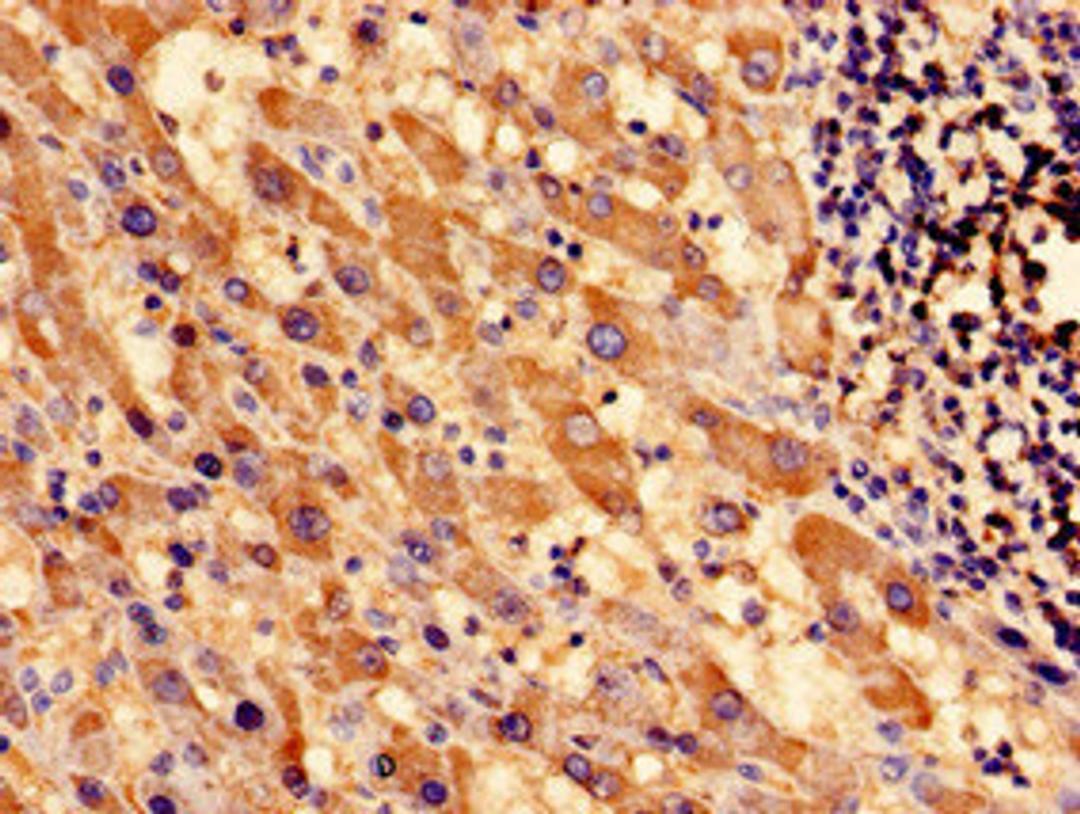 Immunocytochemistry analysis of human liver cancer using CSB-PA022392EA01HU at dilution of 1:100