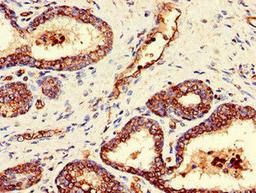 Immunohistochemistry of paraffin-embedded human prostate cancer using CSB-PA863993LA01HU at dilution of 1:100