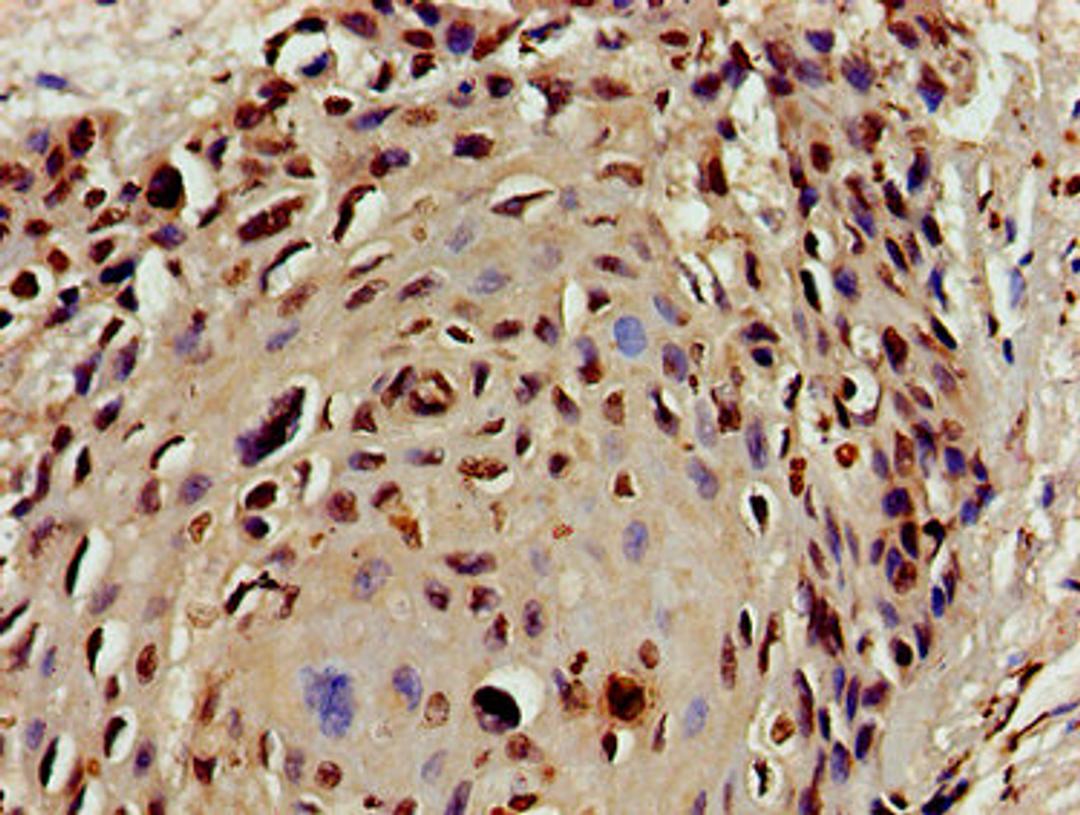 Immunohistochemistry of paraffin-embedded human cervical cancer using CSB-PA010429PA16nacHU at dilution of 1:100