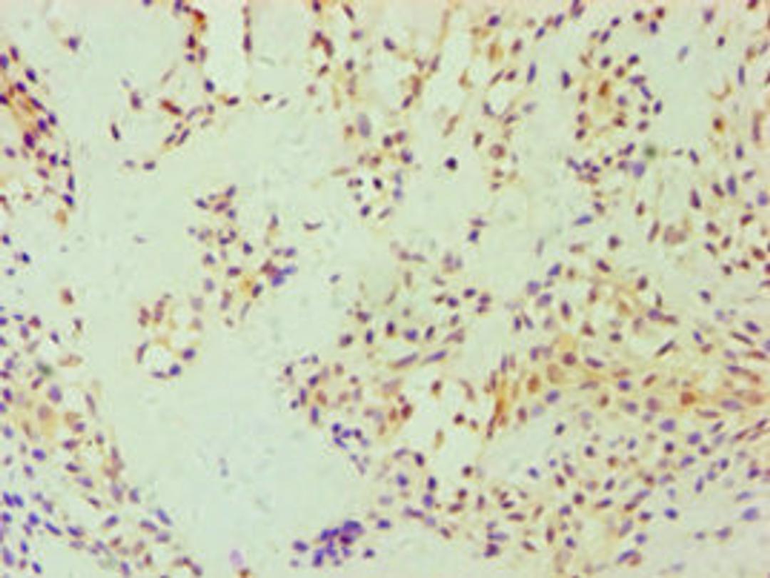 Immunohistochemistry of paraffin-embedded human breast cancer using CSB-PA006766ESR2HU at dilution of 1:100