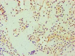 Immunohistochemistry of paraffin-embedded human breast cancer using CSB-PA006766ESR2HU at dilution of 1:100