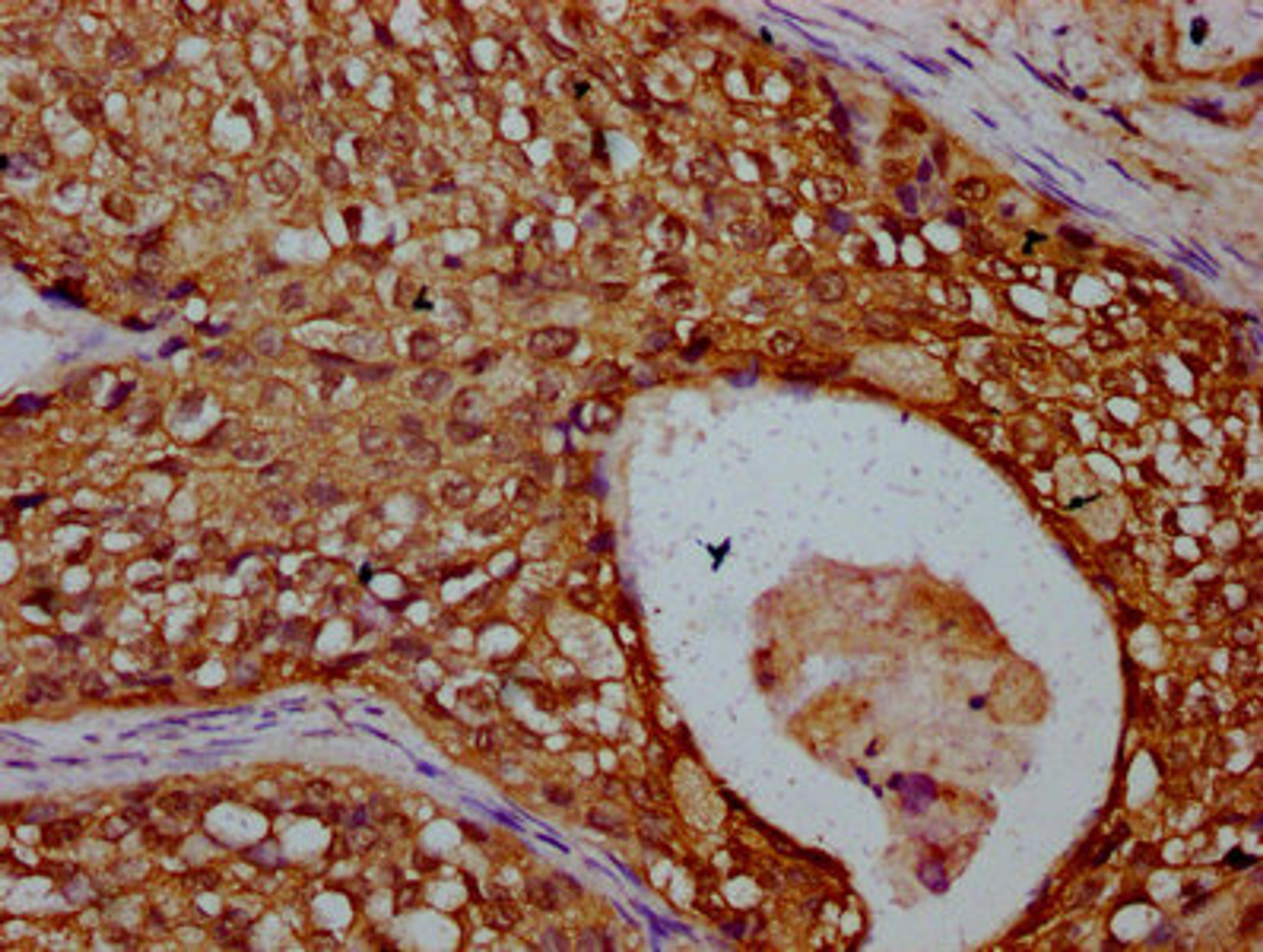 IHC image of CSB-PA883599LA01HU diluted at 1:300 and staining in paraffin-embedded human cervical cancer performed on a Leica BondTM system. After dewaxing and hydration, antigen retrieval was mediated by high pressure in a citrate buffer (pH 6.0). Section was blocked with 10% normal goat serum 30min at RT. Then primary antibody (1% BSA) was incubated at 4&deg;C overnight. The primary is detected by a biotinylated secondary antibody and visualized using an HRP conjugated SP system.