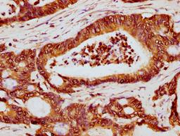 IHC image of CSB-PA010389OA119ncrHU diluted at 1:5 and staining in paraffin-embedded human colon cancer performed on a Leica BondTM system. After dewaxing and hydration, antigen retrieval was mediated by high pressure in a citrate buffer (pH 6.0). Section was blocked with 10% normal goat serum 30min at RT. Then primary antibody (1% BSA) was incubated at 4°C overnight. The primary is detected by a biotinylated secondary antibody and visualized using an HRP conjugated SP system.