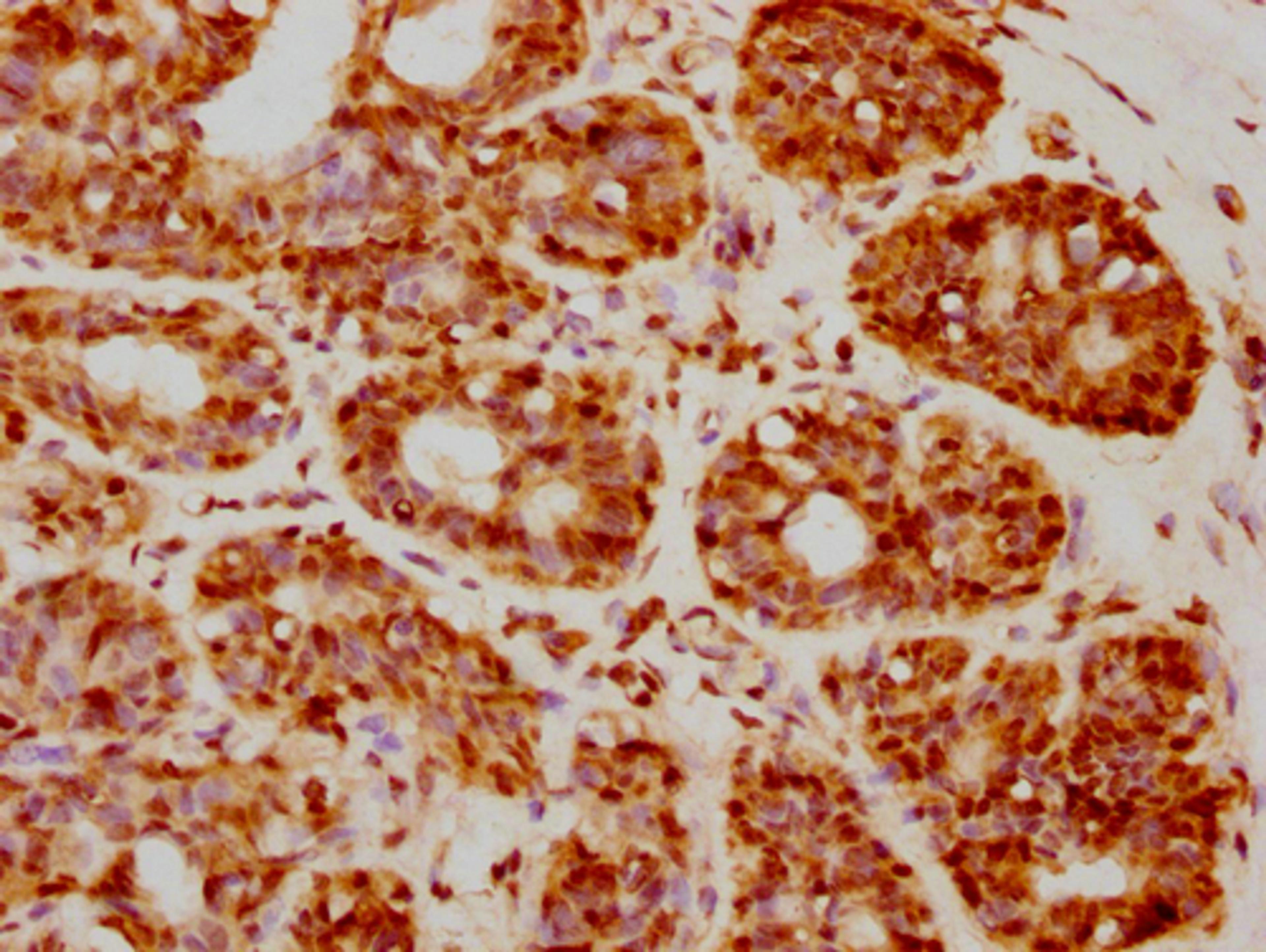 IHC image of CSB-PA010403PA05nforHU diluted at 1:20 and staining in paraffin-embedded human breast cancer performed on a Leica BondTM system. After dewaxing and hydration, antigen retrieval was mediated by high pressure in a citrate buffer (pH 6.0). Section was blocked with 10% normal goat serum 30min at RT. Then primary antibody (1% BSA) was incubated at 4°C overnight. The primary is detected by a biotinylated secondary antibody and visualized using an HRP conjugated SP system.