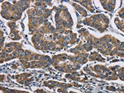 The image is immunohistochemistry of paraffin-embedded Human breast cancer tissue using CSB-PA874417(AGER Antibody) at dilution 1/70. (Original magnification: ×200)