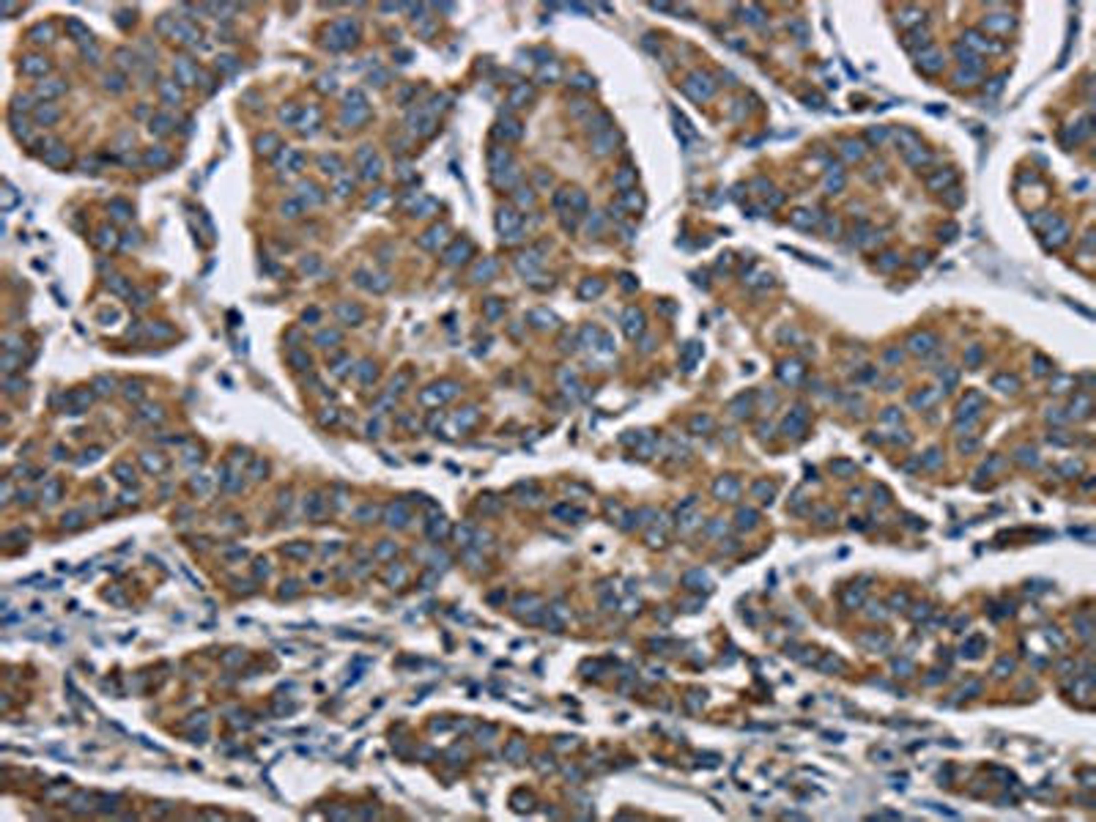 The image is immunohistochemistry of paraffin-embedded Human breast cancer tissue using CSB-PA874417(AGER Antibody) at dilution 1/70. (Original magnification: ×200)