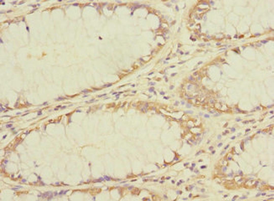 Immunohistochemistry of paraffin-embedded human colon cancer using CSB-PA023803LA01HU at dilution of 1:100
