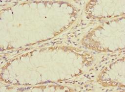 Immunohistochemistry of paraffin-embedded human colon cancer using CSB-PA023803LA01HU at dilution of 1:100