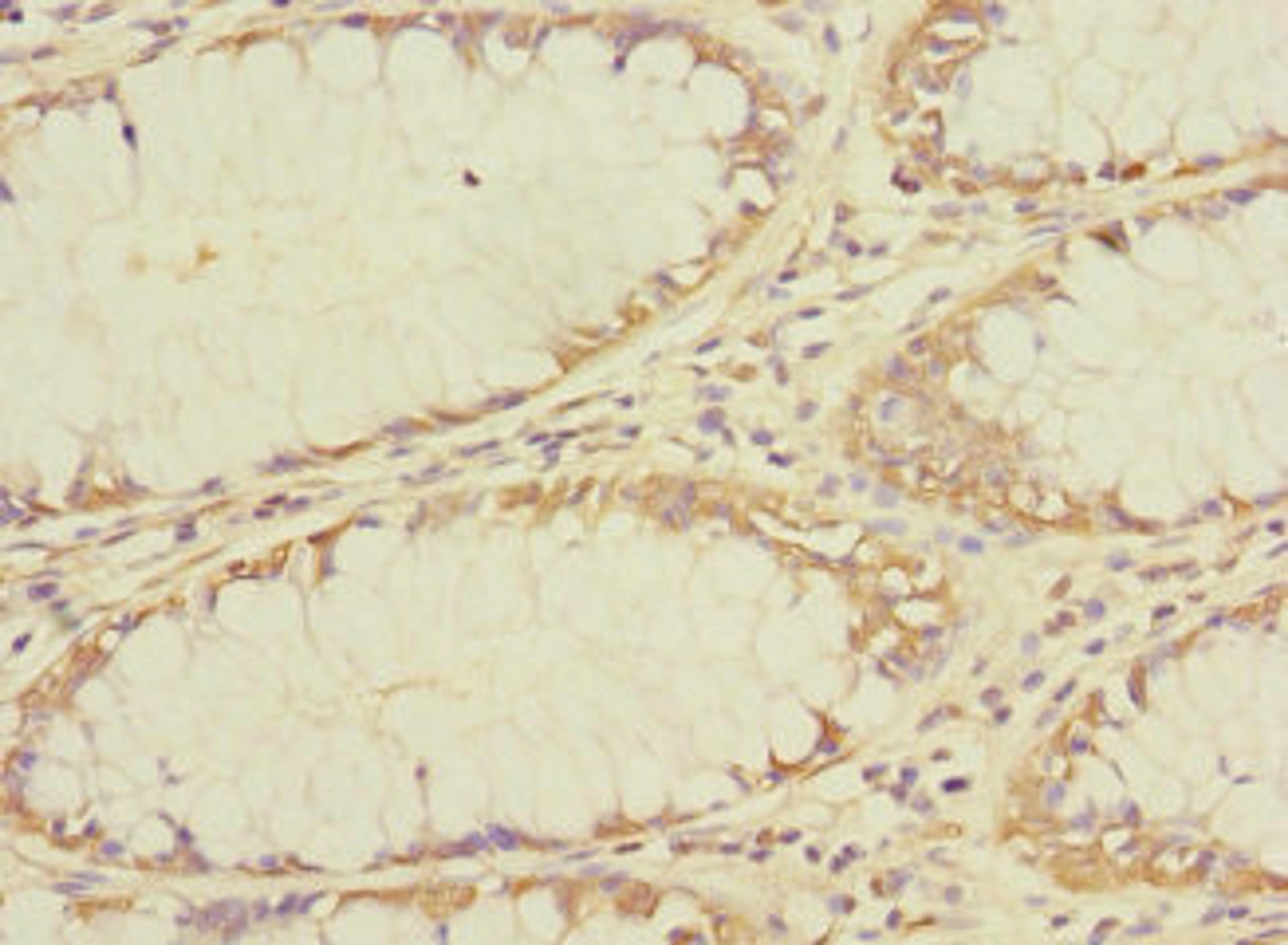 Immunohistochemistry of paraffin-embedded human colon cancer using CSB-PA023803LA01HU at dilution of 1:100