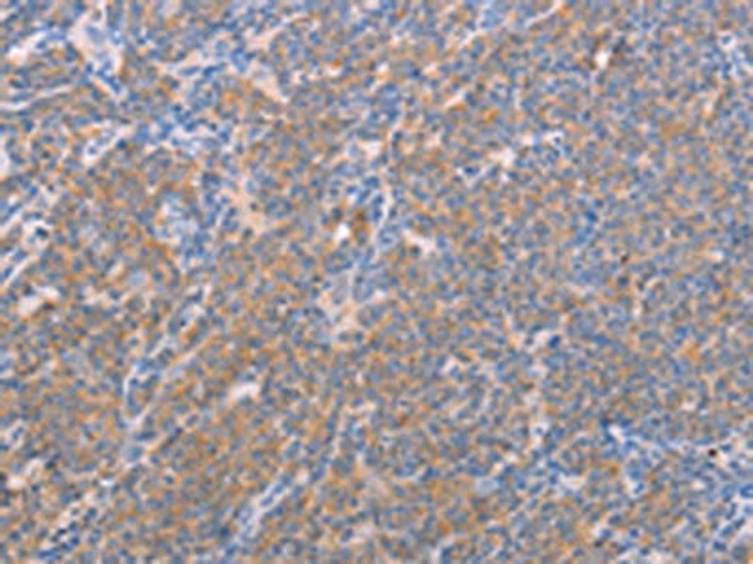 The image on the left is immunohistochemistry of paraffin-embedded Human lymphoma tissue using CSB-PA439037(NFKBIE Antibody) at dilution 1/25, on the right is treated with fusion protein. (Original magnification: ×200)