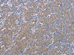 The image on the left is immunohistochemistry of paraffin-embedded Human lymphoma tissue using CSB-PA439037(NFKBIE Antibody) at dilution 1/25, on the right is treated with fusion protein. (Original magnification: ×200)
