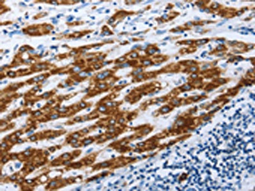 The image on the left is immunohistochemistry of paraffin-embedded Human liver cancer tissue using CSB-PA068462(AIFM1 Antibody) at dilution 1/30, on the right is treated with fusion protein. (Original magnification: ×200)