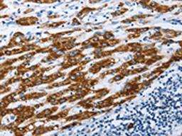 The image on the left is immunohistochemistry of paraffin-embedded Human liver cancer tissue using CSB-PA068462(AIFM1 Antibody) at dilution 1/30, on the right is treated with fusion protein. (Original magnification: ×200)