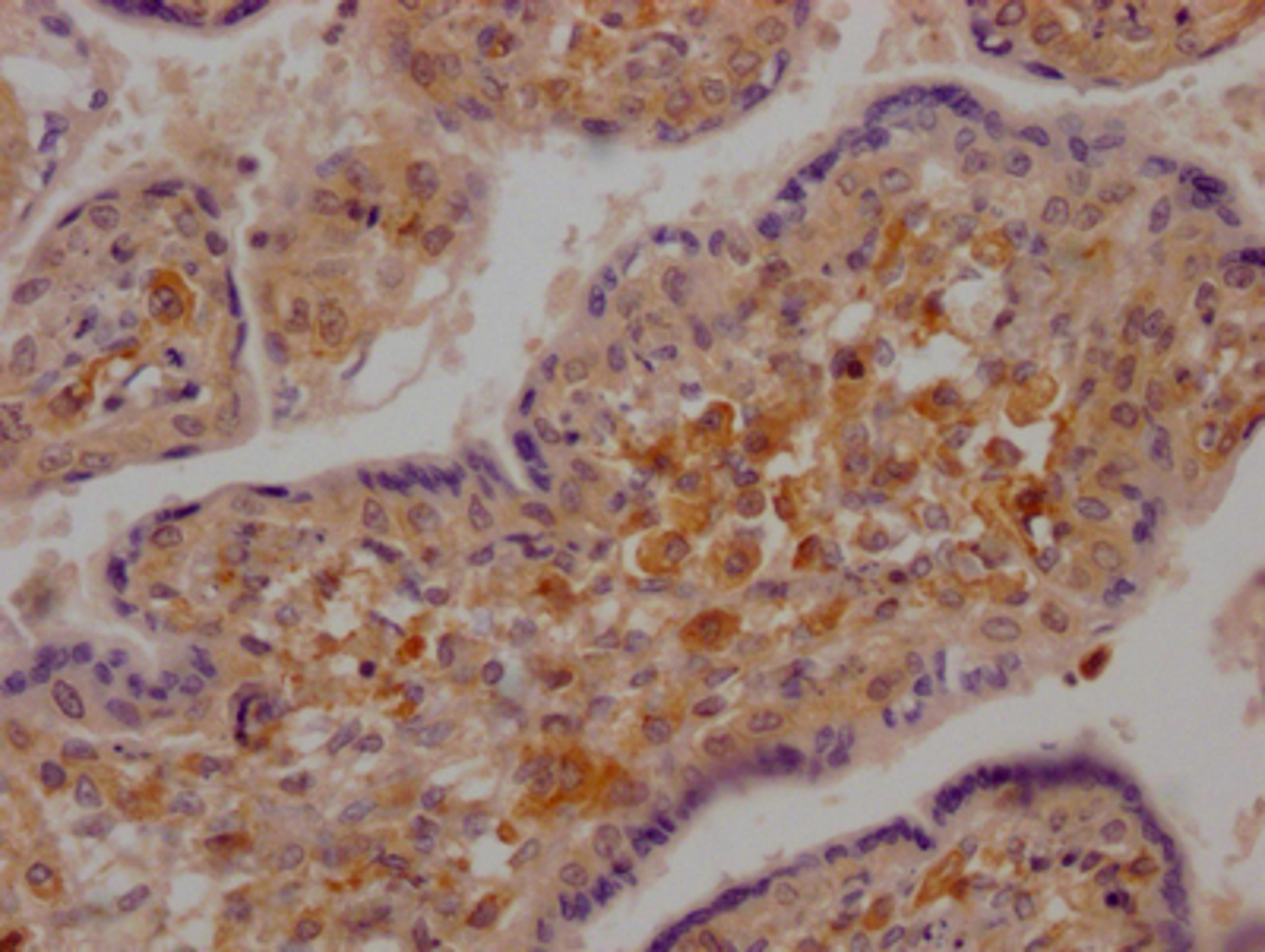 IHC image of CSB-RA207378A0HU diluted at 1:100 and staining in paraffin-embedded human placenta tissue performed on a Leica BondTM system. After dewaxing and hydration, antigen retrieval was mediated by high pressure in a citrate buffer (pH 6.0). Section was blocked with 10% normal goat serum 30min at RT. Then primary antibody (1% BSA) was incubated at 4℃ overnight. The primary is detected by a Goat anti-rabbit IgG polymer labeled by HRP and visualized using 0.05% DAB.