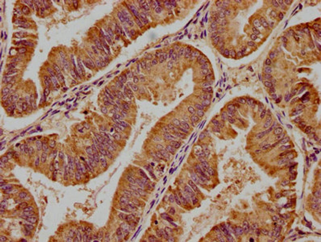 IHC image of CSB-PA001621LA01HU diluted at 1:400 and staining in paraffin-embedded human endometrial cancer performed on a Leica BondTM system. After dewaxing and hydration, antigen retrieval was mediated by high pressure in a citrate buffer (pH 6.0). Section was blocked with 10% normal goat serum 30min at RT. Then primary antibody (1% BSA) was incubated at 4°C overnight. The primary is detected by a biotinylated secondary antibody and visualized using an HRP conjugated SP system.