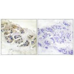 Immunohistochemistry analysis of paraffin-embedded human breast carcinoma tissue using Mammaglobin antibody.