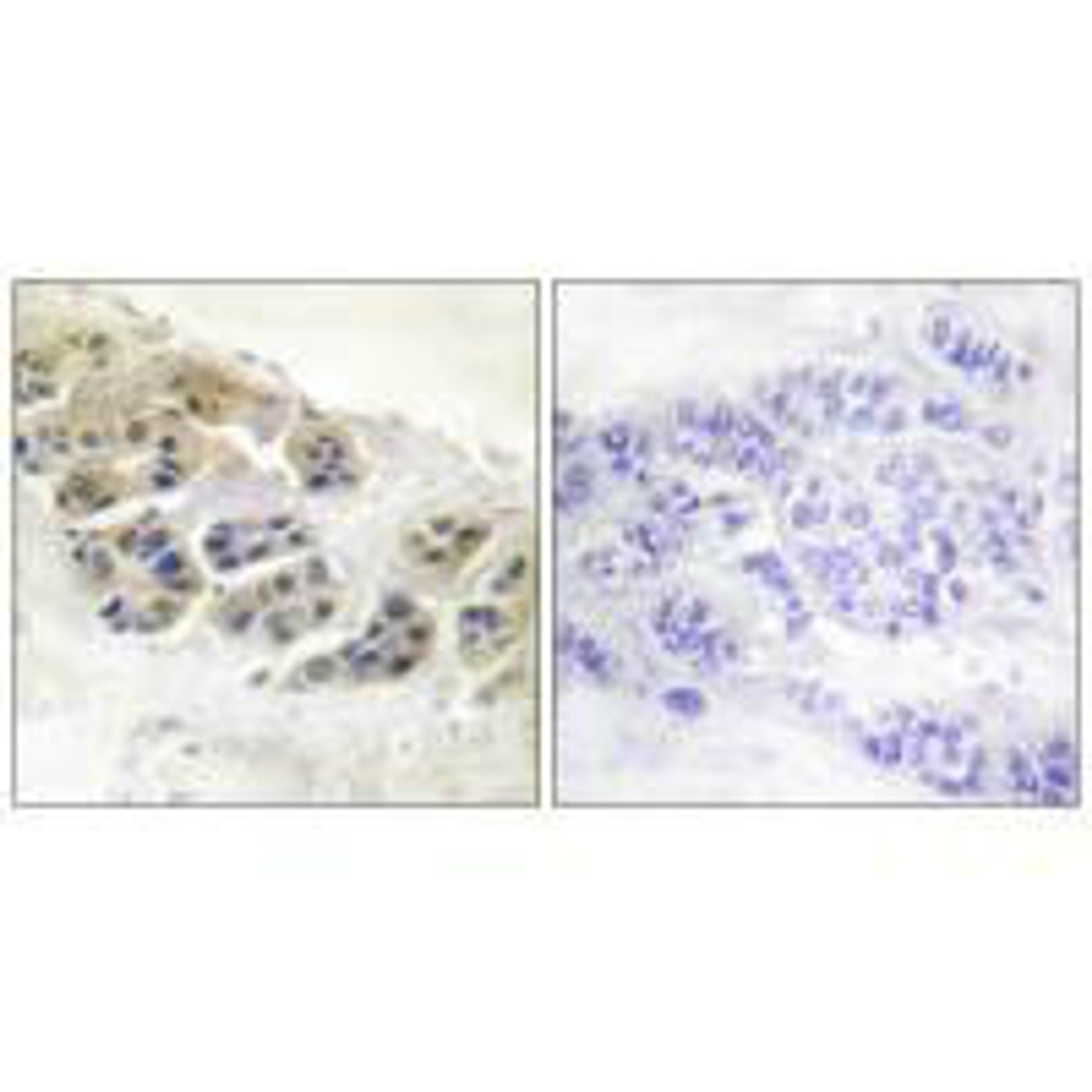 Immunohistochemistry analysis of paraffin-embedded human breast carcinoma tissue using Mammaglobin antibody.