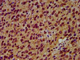 IHC image of CSB-PA021288LA01HU diluted at 1:600 and staining in paraffin-embedded human glioma performed on a Leica BondTM system. After dewaxing and hydration, antigen retrieval was mediated by high pressure in a citrate buffer (pH 6.0). Section was blocked with 10% normal goat serum 30min at RT. Then primary antibody (1% BSA) was incubated at 4&deg;C overnight. The primary is detected by a biotinylated secondary antibody and visualized using an HRP conjugated SP system.