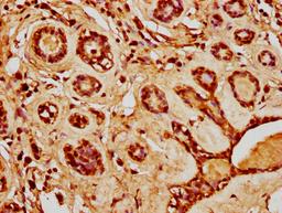 IHC image of CSB-PA010429PA20nacHU diluted at 1:20 and staining in paraffin-embedded human breast cancer performed on a Leica BondTM system. After dewaxing and hydration, antigen retrieval was mediated by high pressure in a citrate buffer (pH 6.0). Section was blocked with 10% normal goat serum 30min at RT. Then primary antibody (1% BSA) was incubated at 4°C overnight. The primary is detected by a biotinylated secondary antibody and visualized using an HRP conjugated SP system.