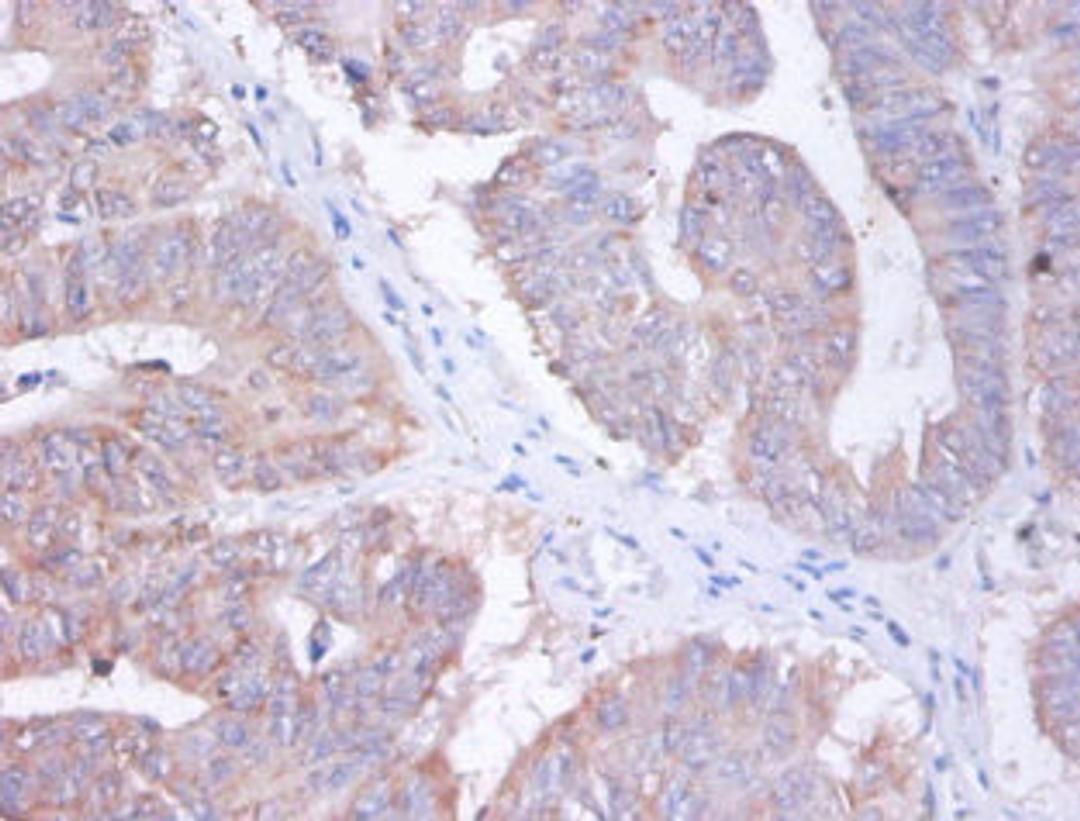Immunohistochemistry of paraffin-embedded human colon cancer using CSB-PA02604A0Rb at dilution of 1:100
