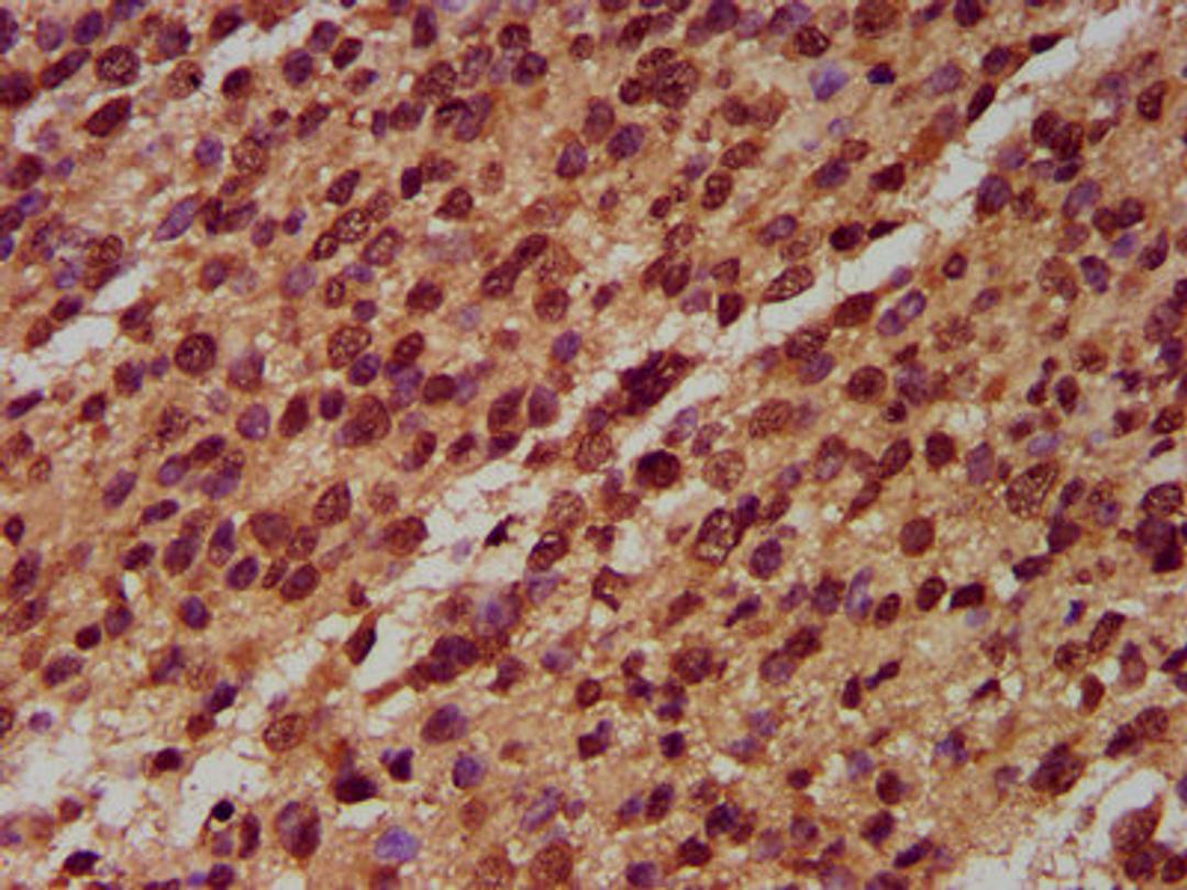 IHC image of CSB-PA015874LA01HU diluted at 1:400 and staining in paraffin-embedded human glioma performed on a Leica BondTM system. After dewaxing and hydration, antigen retrieval was mediated by high pressure in a citrate buffer (pH 6.0). Section was blocked with 10% normal goat serum 30min at RT. Then primary antibody (1% BSA) was incubated at 4&deg;C overnight. The primary is detected by a biotinylated secondary antibody and visualized using an HRP conjugated SP system.