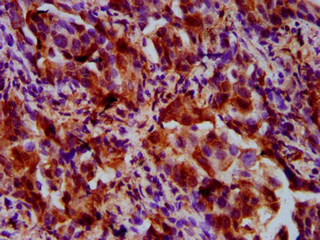 IHC image of CSB-PA883646LA01HU diluted at 1:500 and staining in paraffin-embedded human lung cancer performed on a Leica BondTM system. After dewaxing and hydration, antigen retrieval was mediated by high pressure in a citrate buffer (pH 6.0). Section was blocked with 10% normal goat serum 30min at RT. Then primary antibody (1% BSA) was incubated at 4&deg;C overnight. The primary is detected by a biotinylated secondary antibody and visualized using an HRP conjugated SP system.