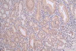 IHC image of CSB-RA792403A0HU diluted at 1:100 and staining in paraffin-embedded human gastric cancer performed on a Leica BondTM system. After dewaxing and hydration, antigen retrieval was mediated by high pressure in a citrate buffer (pH 6.0). Section was blocked with 10% normal goat serum 30min at RT. Then primary antibody (1% BSA) was incubated at 4°C overnight. The primary is detected by a Goat anti-rabbit polymer IgG labeled by HRP and visualized using 0.06% DAB.