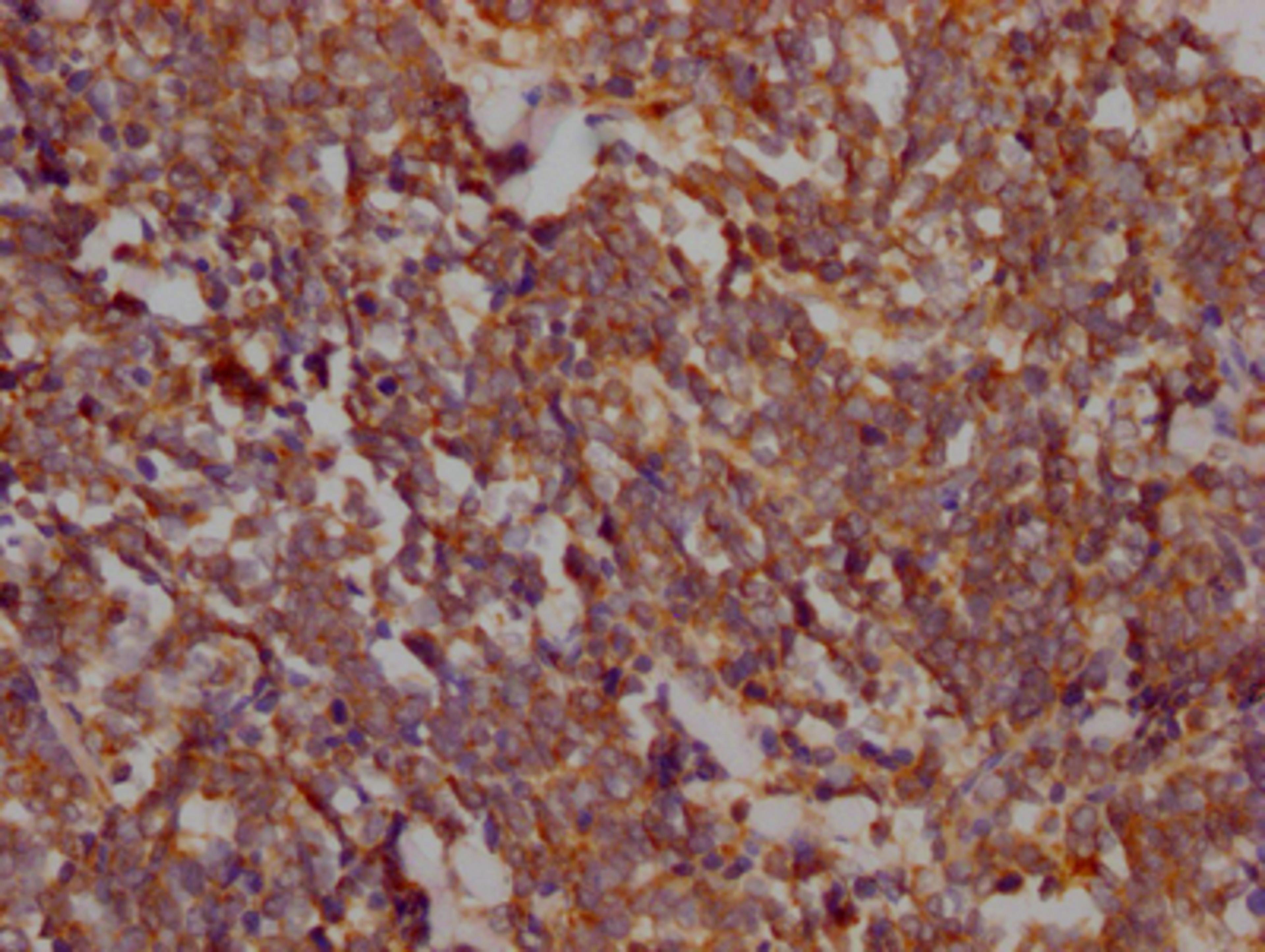 IHC image of CSB-RA198162A0HU diluted at 1:100 and staining in paraffin-embedded human lung cancer performed on a Leica BondTM system. After dewaxing and hydration, antigen retrieval was mediated by high pressure in a citrate buffer (pH 6.0). Section was blocked with 10% normal goat serum 30min at RT. Then primary antibody (1% BSA) was incubated at 4℃ overnight. The primary is detected by a Goat anti-rabbit IgG polymer labeled by HRP and visualized using 0.05% DAB.