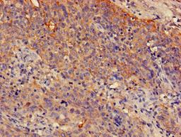 Immunohistochemistry of paraffin-embedded human cervical cancer using CSB-PA022610LA01HU at dilution of 1:100