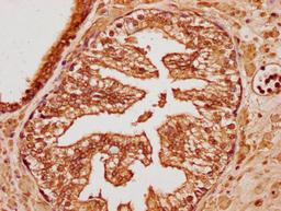 IHC image of CSB-PA750884LA01HU diluted at 1:100 and staining in paraffin-embedded human endometrial cancer performed on a Leica BondTM system. After dewaxing and hydration, antigen retrieval was mediated by high pressure in a citrate buffer (pH 6.0). Section was blocked with 10% normal goat serum 30min at RT. Then primary antibody (1% BSA) was incubated at 4&deg;C overnight. The primary is detected by a biotinylated secondary antibody and visualized using an HRP conjugated SP system.