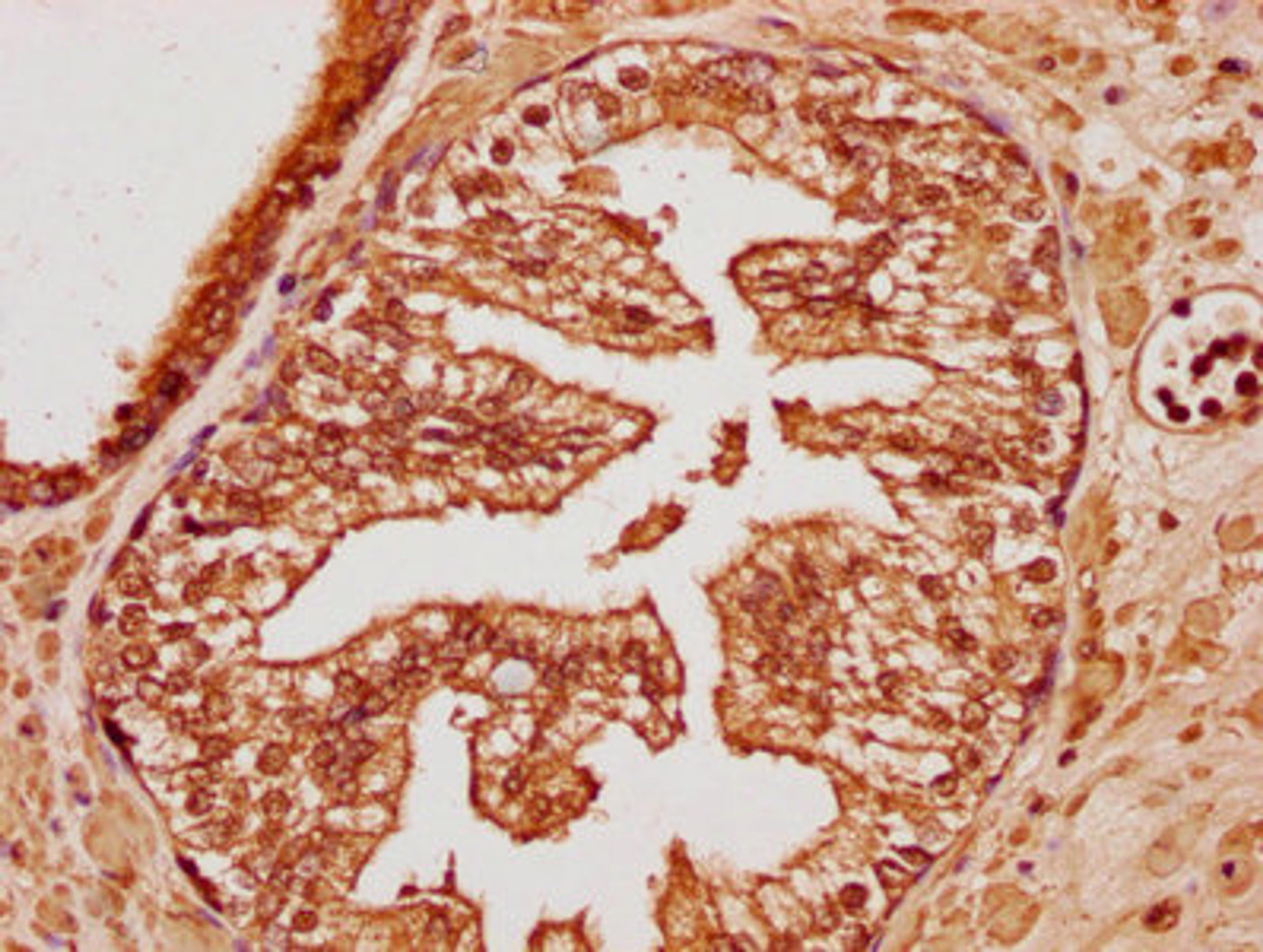 IHC image of CSB-PA750884LA01HU diluted at 1:100 and staining in paraffin-embedded human endometrial cancer performed on a Leica BondTM system. After dewaxing and hydration, antigen retrieval was mediated by high pressure in a citrate buffer (pH 6.0). Section was blocked with 10% normal goat serum 30min at RT. Then primary antibody (1% BSA) was incubated at 4°C overnight. The primary is detected by a biotinylated secondary antibody and visualized using an HRP conjugated SP system.