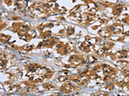 The image on the left is immunohistochemistry of paraffin-embedded Human thyroid cancer tissue using CSB-PA841145(RAP1B Antibody) at dilution 1/50, on the right is treated with fusion protein. (Original magnification: ×200)