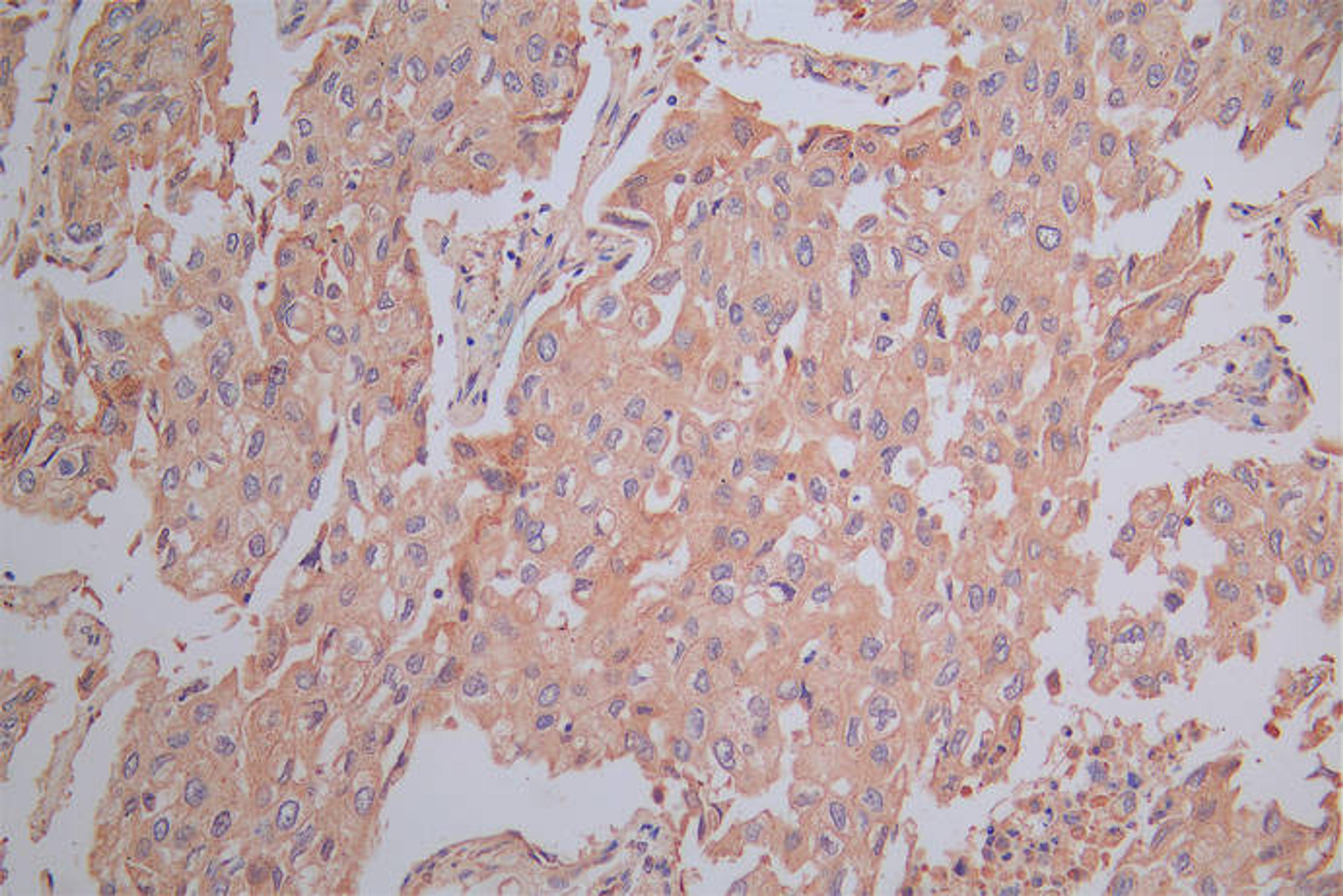 IHC image of CSB-RA021369MA1HU diluted at 1:200 and staining in paraffin-embedded human lung cancer performed on a Leica BondTM system. After dewaxing and hydration,  antigen retrieval was mediated by high pressure in a citrate buffer (pH 6.0). Section was blocked with 10% normal goat serum 30min at RT. Then primary antibody (1% BSA) was incubated at 4°C overnight. The primary is detected by a Goat anti-Mouse IgG labeled by HRP and visualized using 0.05% DAB.