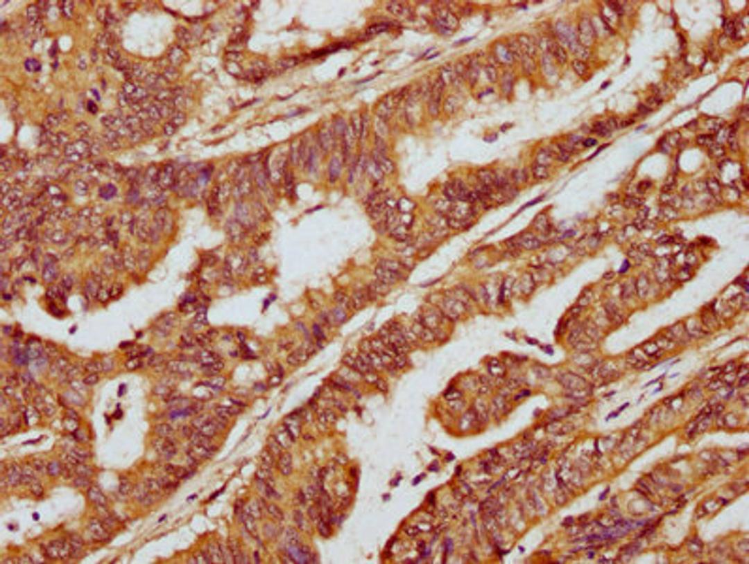 IHC image of CSB-PA715035LA01HU diluted at 1:300 and staining in paraffin-embedded human colon cancer performed on a Leica BondTM system. After dewaxing and hydration, antigen retrieval was mediated by high pressure in a citrate buffer&nbsp;(pH 6.0). Section was blocked with 10% normal goat serum 30min at RT. Then primary antibody&nbsp;(1% BSA) was incubated at 4&deg;C overnight. The primary is detected by a biotinylated secondary antibody and visualized using an HRP conjugated SP system.