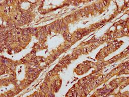 IHC image of CSB-PA715035LA01HU diluted at 1:300 and staining in paraffin-embedded human colon cancer performed on a Leica BondTM system. After dewaxing and hydration, antigen retrieval was mediated by high pressure in a citrate buffer&nbsp;(pH 6.0). Section was blocked with 10% normal goat serum 30min at RT. Then primary antibody&nbsp;(1% BSA) was incubated at 4&deg;C overnight. The primary is detected by a biotinylated secondary antibody and visualized using an HRP conjugated SP system.