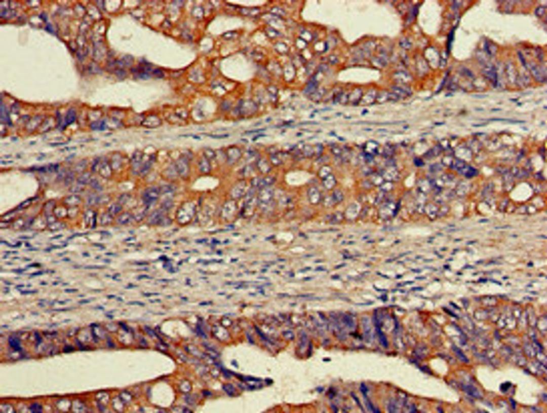 Immunohistochemistry of paraffin-embedded human colon cancer using CSB-PA007523LA01HU at dilution of 1:100