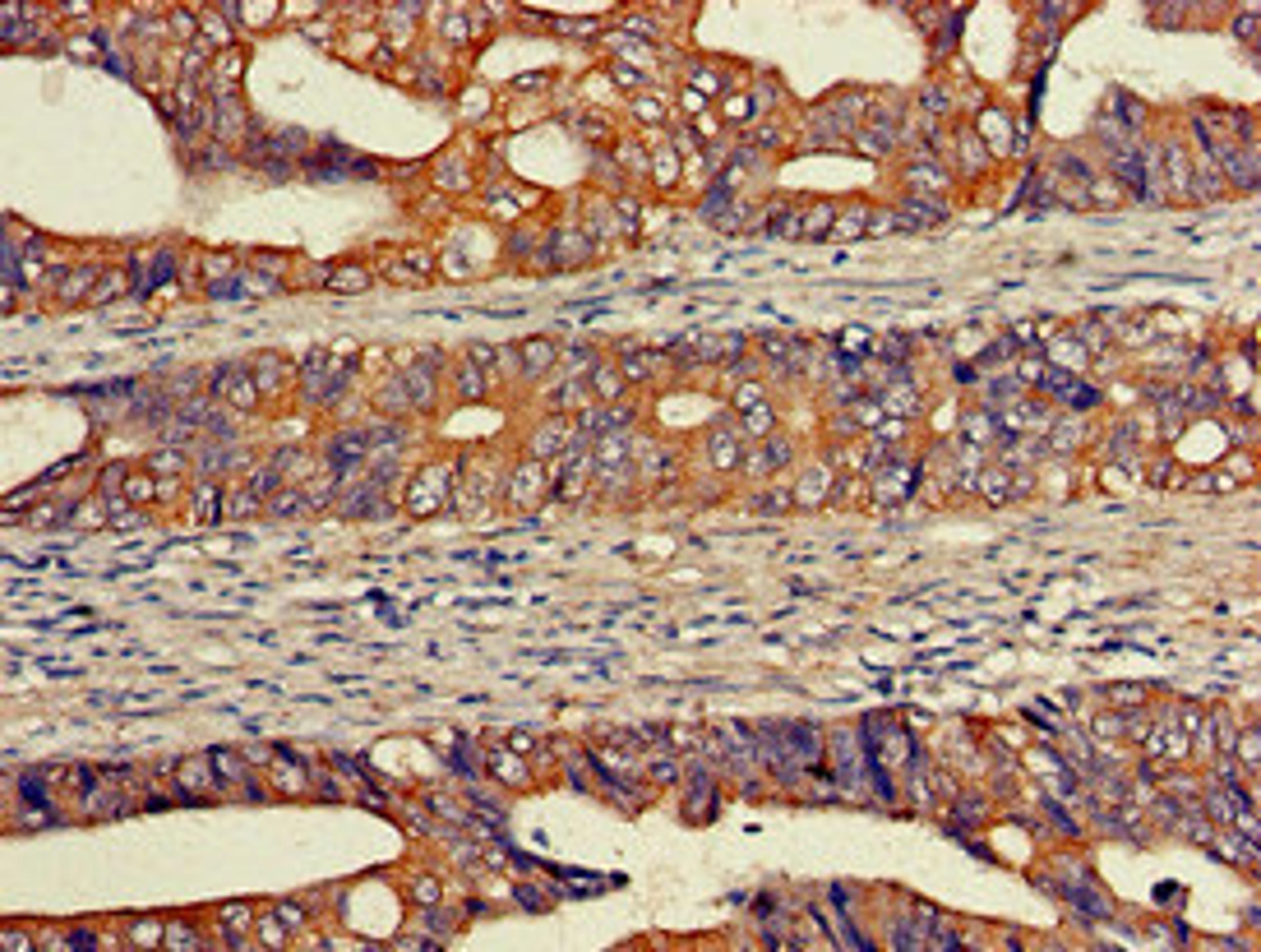 Immunohistochemistry of paraffin-embedded human colon cancer using CSB-PA007523LA01HU at dilution of 1:100