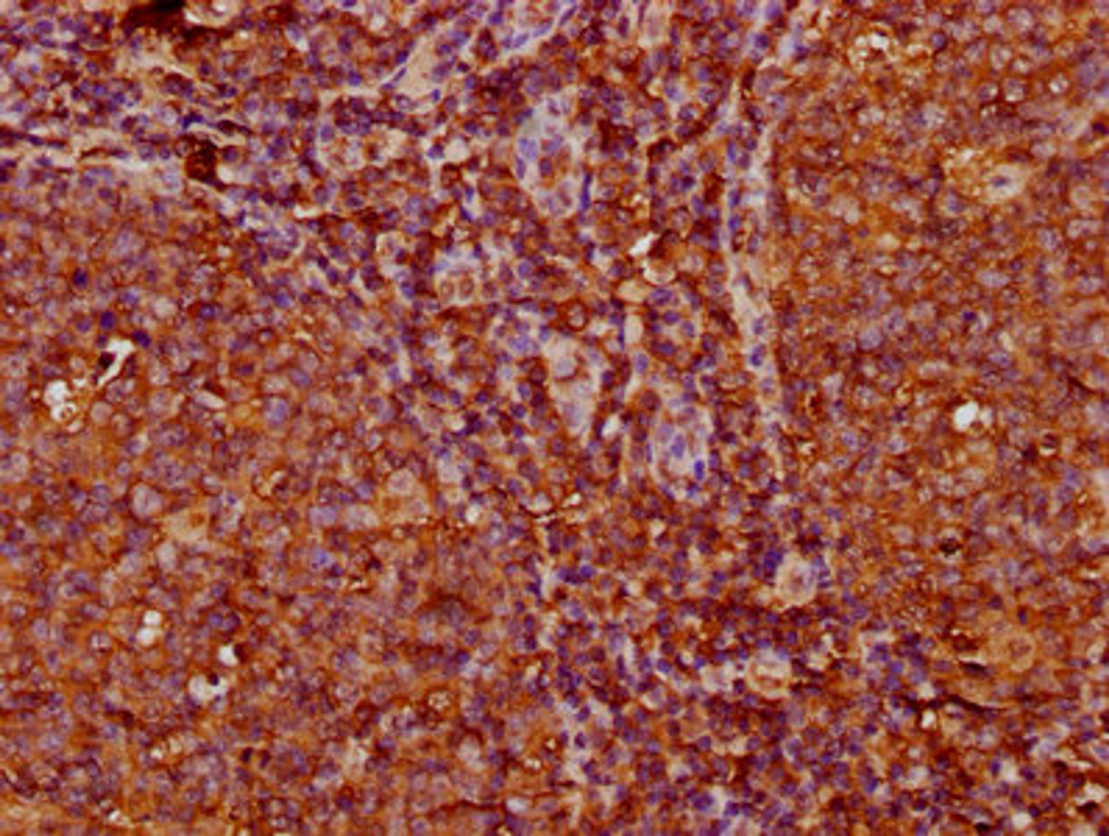 IHC image of CSB-PA011340LA01HU diluted at 1:200 and staining in paraffin-embedded human tonsil tissue performed on a Leica BondTM system. After dewaxing and hydration, antigen retrieval was mediated by high pressure in a citrate buffer (pH 6.0). Section was blocked with 10% normal goat serum 30min at RT. Then primary antibody (1% BSA) was incubated at 4&deg;C overnight. The primary is detected by a biotinylated secondary antibody and visualized using an HRP conjugated SP system.