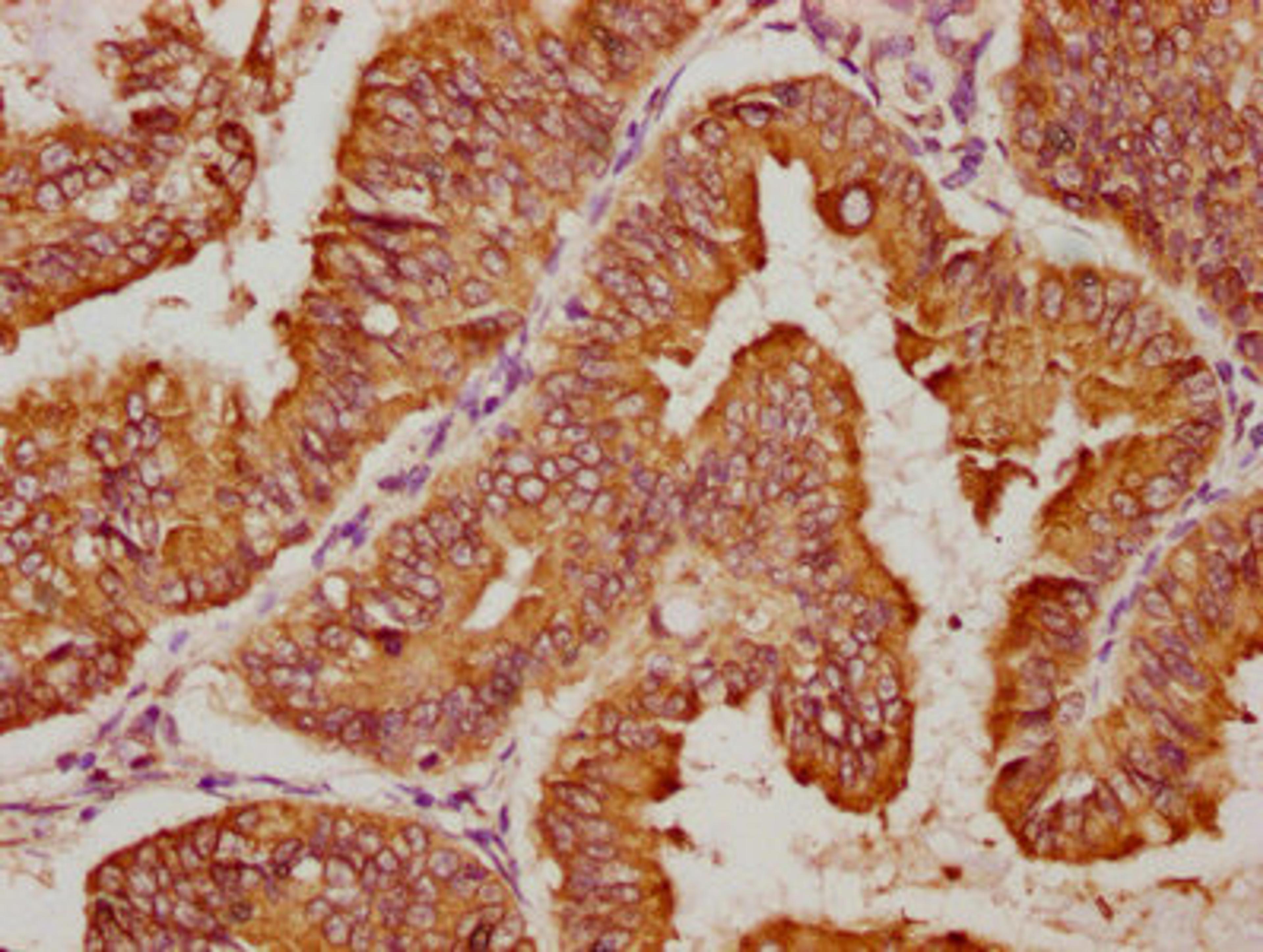 IHC image of CSB-PA809006LA01HU diluted at 1:100 and staining in paraffin-embedded human endometrial cancer performed on a Leica BondTM system. After dewaxing and hydration, antigen retrieval was mediated by high pressure in a citrate buffer (pH 6.0). Section was blocked with 10% normal goat serum 30min at RT. Then primary antibody (1% BSA) was incubated at 4°C overnight. The primary is detected by a biotinylated secondary antibody and visualized using an HRP conjugated SP system.
