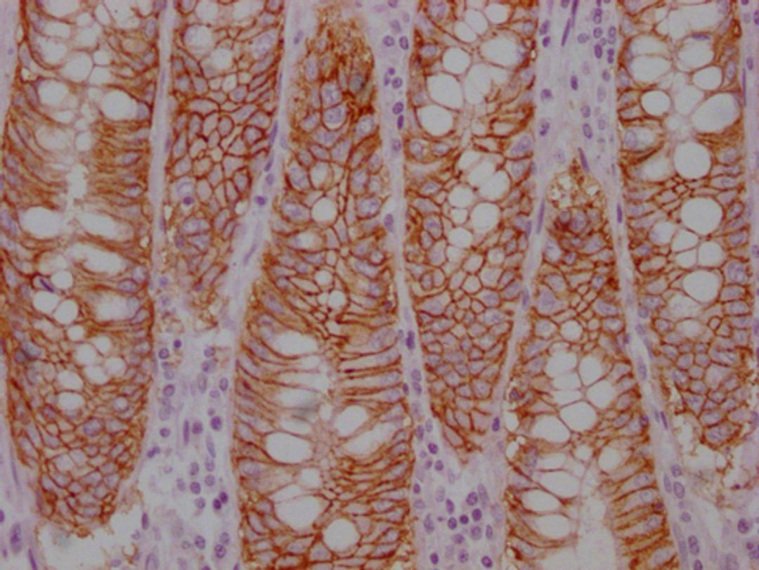 IHC image of CSB-MA221818 diluted at 1:100 and staining in paraffin-embedded human colon cancer performed on a Leica BondTM system. After dewaxing and hydration, antigen retrieval was mediated by high pressure in a citrate buffer (pH 6.0). Section was blocked with 10% normal goat serum 30min at RT. Then primary antibody (1% BSA) was incubated at 4°C overnight. The primary is detected by a Goat anti-mouse IgG polymer labeled by HRP and visualized using 0.05% DAB.