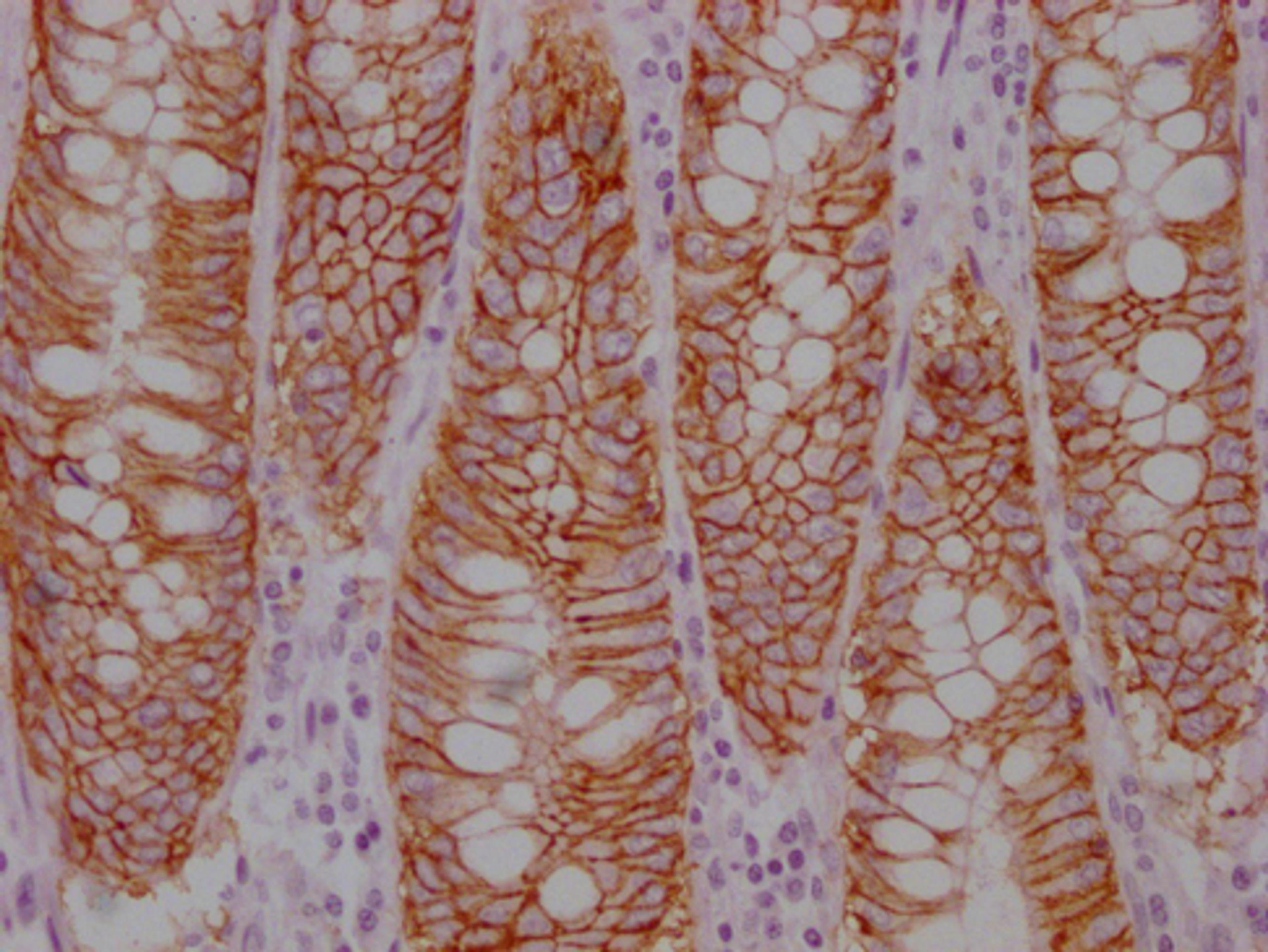 IHC image of CSB-MA221818 diluted at 1:100 and staining in paraffin-embedded human colon cancer performed on a Leica BondTM system. After dewaxing and hydration, antigen retrieval was mediated by high pressure in a citrate buffer (pH 6.0). Section was blocked with 10% normal goat serum 30min at RT. Then primary antibody (1% BSA) was incubated at 4°C overnight. The primary is detected by a Goat anti-mouse IgG polymer labeled by HRP and visualized using 0.05% DAB.
