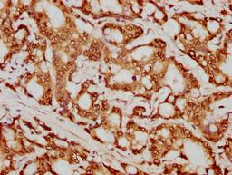 IHC image of CSB-PA010429PA79nforHU diluted at 1:20 and staining in paraffin-embedded human colon cancer performed on a Leica BondTM system. After dewaxing and hydration, antigen retrieval was mediated by high pressure in a citrate buffer (pH 6.0). Section was blocked with 10% normal goat serum 30min at RT. Then primary antibody (1% BSA) was incubated at 4°C overnight. The primary is detected by a biotinylated secondary antibody and visualized using an HRP conjugated SP system.