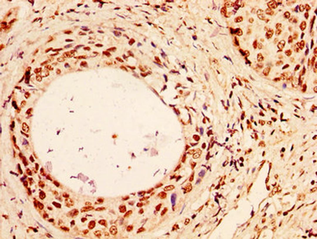 IHC image of CSB-PA010378OA96nhibHU diluted at 1:50 and staining in paraffin-embedded human cervical cancer performed on a Leica BondTM system. After dewaxing and hydration, antigen retrieval was mediated by high pressure in a citrate buffer (pH 6.0). Section was blocked with 10% normal goat serum 30min at RT. Then primary antibody (1% BSA) was incubated at 4°C overnight. The primary is detected by a biotinylated secondary antibody and visualized using an HRP conjugated SP system.
