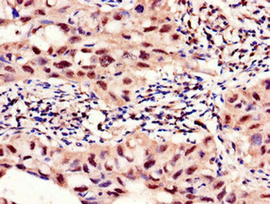 Immunohistochemistry of paraffin-embedded human lung cancer using CSB-PA017818LA01HU at dilution of 1:100
