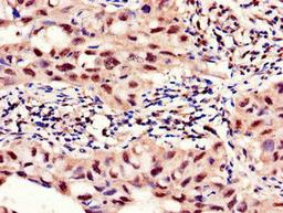 Immunohistochemistry of paraffin-embedded human lung cancer using CSB-PA017818LA01HU at dilution of 1:100