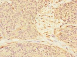 Immunohistochemistry of paraffin-embedded human ovarian cancer using CSB-PA754570ESR2HU at dilution of 1:100