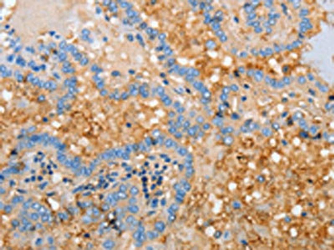 The image on the left is immunohistochemistry of paraffin-embedded Human thyroid cancer tissue using CSB-PA297198(APOH Antibody) at dilution 1/30, on the right is treated with fusion protein. (Original magnification: ×200)