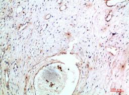 Immunohistochemical analysis of paraffin-embedded human-cervical-cancer, antibody was diluted at 1:200