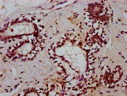 IHC image of CSB-PA023271LA01HU diluted at 1:600 and staining in paraffin-embedded human breast cancer performed on a Leica BondTM system. After dewaxing and hydration, antigen retrieval was mediated by high pressure in a citrate buffer (pH 6.0). Section was blocked with 10% normal goat serum 30min at RT. Then primary antibody (1% BSA) was incubated at 4&deg;C overnight. The primary is detected by a biotinylated secondary antibody and visualized using an HRP conjugated SP system.