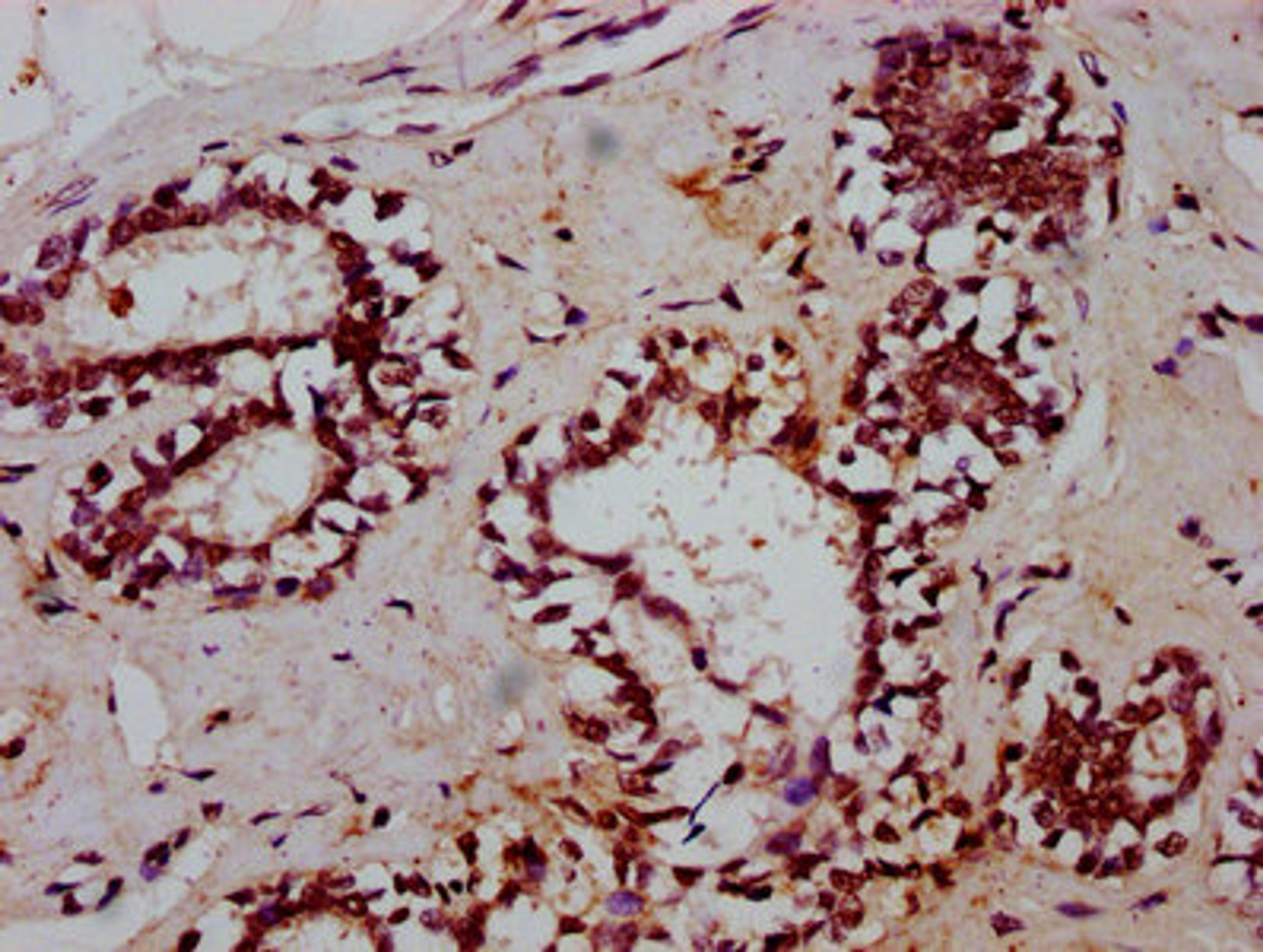 IHC image of CSB-PA023271LA01HU diluted at 1:600 and staining in paraffin-embedded human breast cancer performed on a Leica BondTM system. After dewaxing and hydration, antigen retrieval was mediated by high pressure in a citrate buffer (pH 6.0). Section was blocked with 10% normal goat serum 30min at RT. Then primary antibody (1% BSA) was incubated at 4&deg;C overnight. The primary is detected by a biotinylated secondary antibody and visualized using an HRP conjugated SP system.